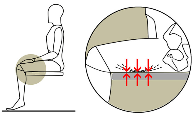 座椅太高时，受力点对大腿的血液循环造成的...
