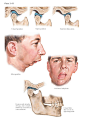 Abnormalities of Temporomandibular Joint