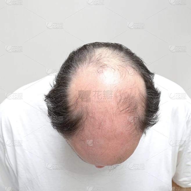 非全秃,秃头症,秃头,情绪压力,仅男人,仅成年人,在上面,中老年男人,人的头部,英国素材-花瓣网
