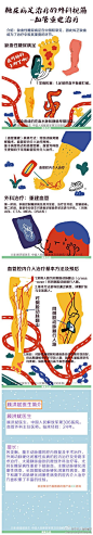【医生文萃】糖尿病足治疗的外科视角——血管重建治疗 @顾洪斌306血管外科 @医生护士那点事