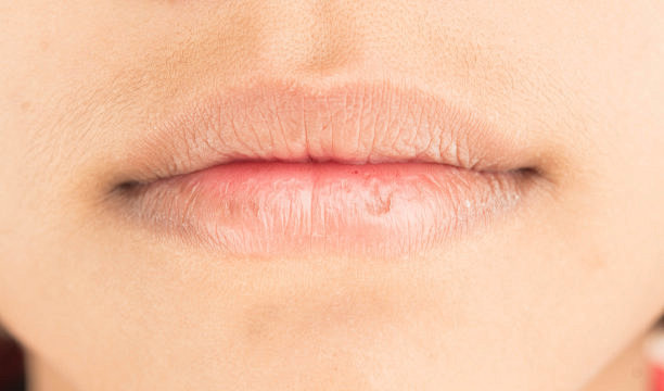 干燥的嘴唇和剥皮照片素材-图片ID：30...