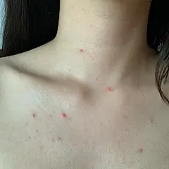 被洗浴传染了水瘊子 传染性软疣 - 小红书