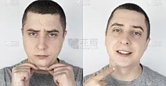 双下巴。在整形手术、颏部成形术或面部重塑手术前后。下巴脂肪去除和面部轮廓矫正。现代医学的概念和身体轮