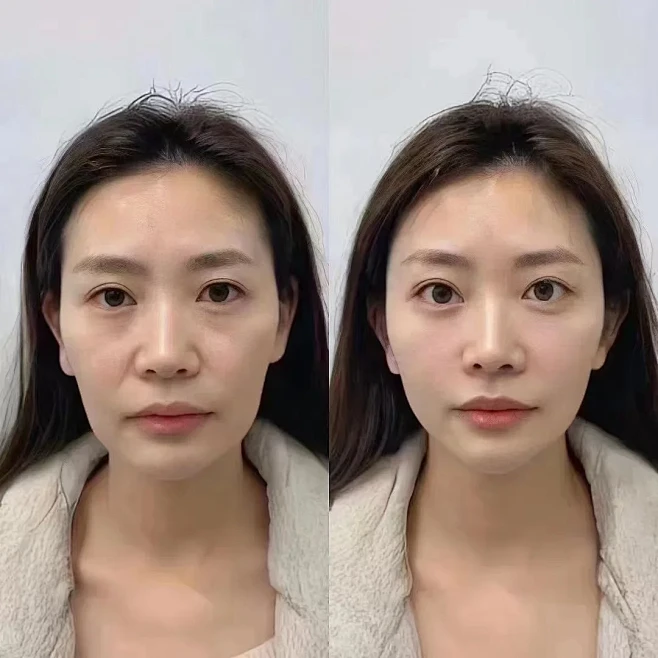 想要年轻态，面部抗衰很重要