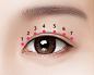 埋线双眼皮：七点埋线法双眼皮手术