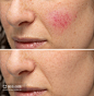 酒糟鼻治疗前后比较,Comparison between before and after a treatment for rosacea - 图虫创意-全球领先正版素材库-Adobe Stock中国独家合作伙伴