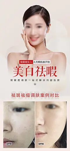 美业祛斑祛痘案例海报