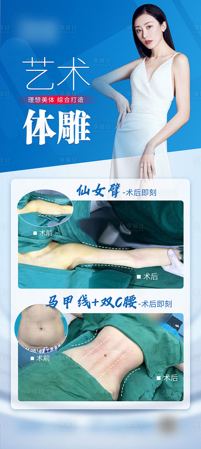 马甲线吸脂案例简约海报-源文件