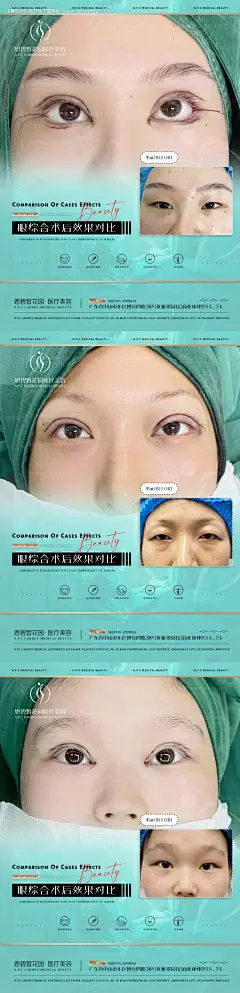 源文件下载【享设计】搜索编号：57300020998533641【医美整形双眼皮眼综合项目系列海报】
