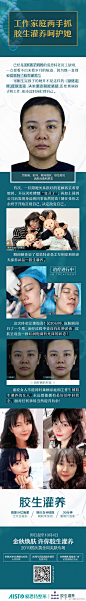 爱思特老员工互相安利的抗衰新品胶生灌养，更新术后反馈。3岁孩子的宝妈慧姐兼顾工作和家庭十分辛苦，这次体验最大的感受是惫态不见了，肤色提亮了很多！ ​​​​