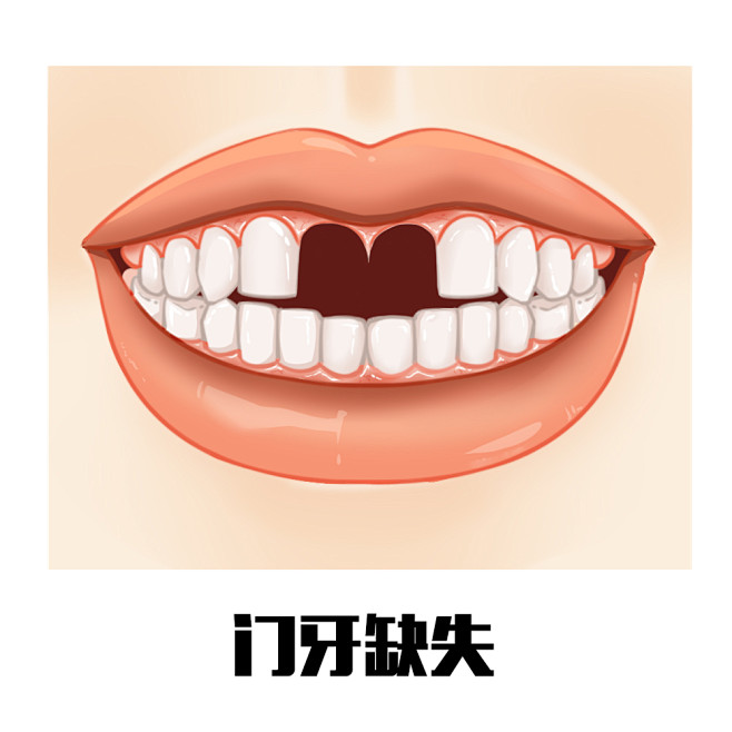 多颗牙缺失  个别牙缺失  门牙缺失  ...