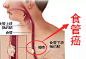 别再“趁热吃”了，我国食道癌发病率最高就是因为总爱“趁热吃”！