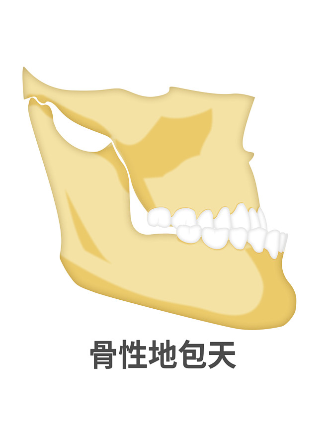 骨性地包天