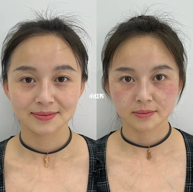 最真实的医美效果对比：法令纹