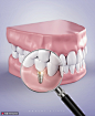 修复牙齿模型种植放大牙髓医美海报海报招贴素材下载-优图网-UPPSD