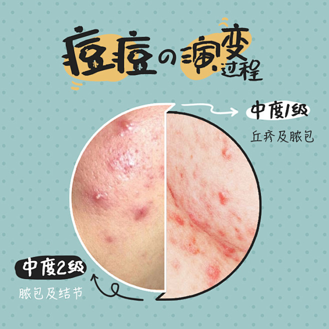 护肤小知识，祛痘科普