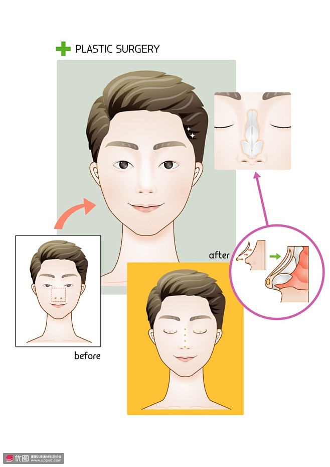 帅哥隆鼻软骨组织自体软骨医美整形插画医疗...