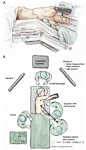 单操作孔胸腔镜下 肺叶切除术 Uniportal video-assisted thoracoscopic lobectomy 【论文医学插画欣赏】国内外文献全文可以为您免费传递！QQ 18147895 活动详情见 O网页链接 ★★★ 喜欢 医学插画 医学美图 医学插图 医学美术 医学可视化 医学插画师 医学动画 请关注我。★★★请前往高能区 ​​​​...展开全文c