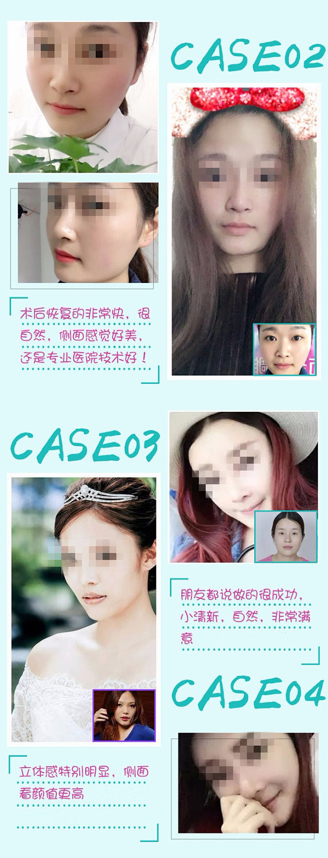 【鼻部】达拉斯综合美鼻 打造韩式小翘鼻 ...