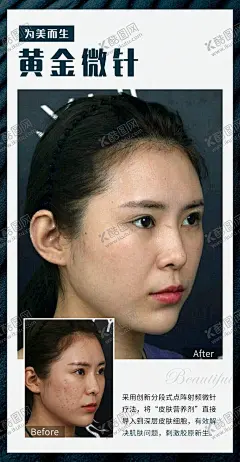 黄金微针对比图 【酷图网】美容,前后对比,微针,装饰画,黄金微针,挂画,医美,疗效,术前,术后,整形,对比图,案例,真人秀,瘦脸,脱毛,双眼皮,隆鼻,隆胸,瘦腿,去眼袋,嫩肤美白,蛋白线雕海报,蛋白线,法令纹,瘦下巴,微整形展架绣,纹展架,隆鼻壁挂画,祛斑对比图,吸脂对比图,微整形对比图,微整形,面部整形,隆鼻对比图,
