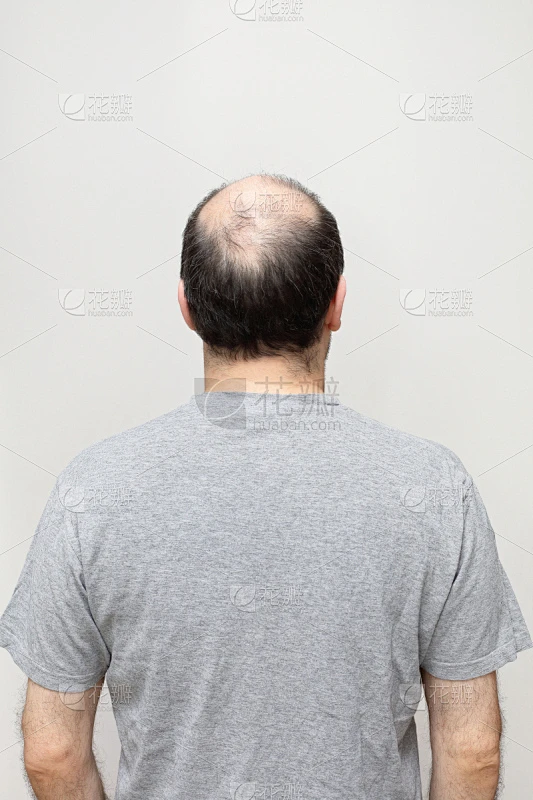 秃头,秃头症,非全秃,垂直画幅,半身像,情绪压力,仅男人,仅成年人,中老年男人,人的头部素材-花瓣网