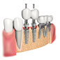 Illustrations for dental implant clinic, Alexander Zvyagintsev