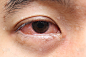 人的眼睛,红色,身体受伤,青光眼,水平画幅,眼痛,情绪压力,结膜炎,特写